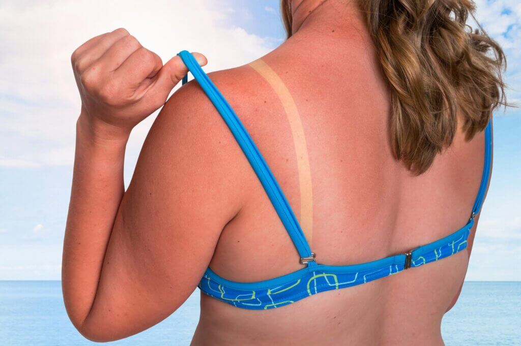 Kůže poškozená UV zářením